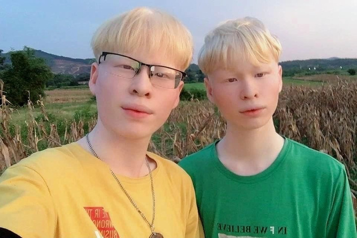 Cuộc sống của cặp song sinh bạch tạng từng nghỉ học để kiếm sống hiện ra sao? - 1