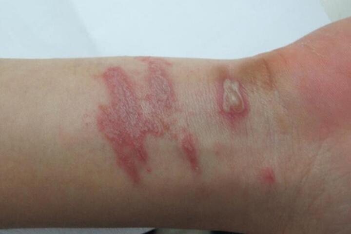 Nhiều người nhập viện do kiến ba khoang: Chuyên gia chỉ rõ sai lầm khi điều trị - 1