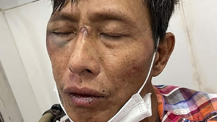 Vây bắt côn đồ đất Cảng nhiễm HIV cầm hung khí chống trả công an - 1