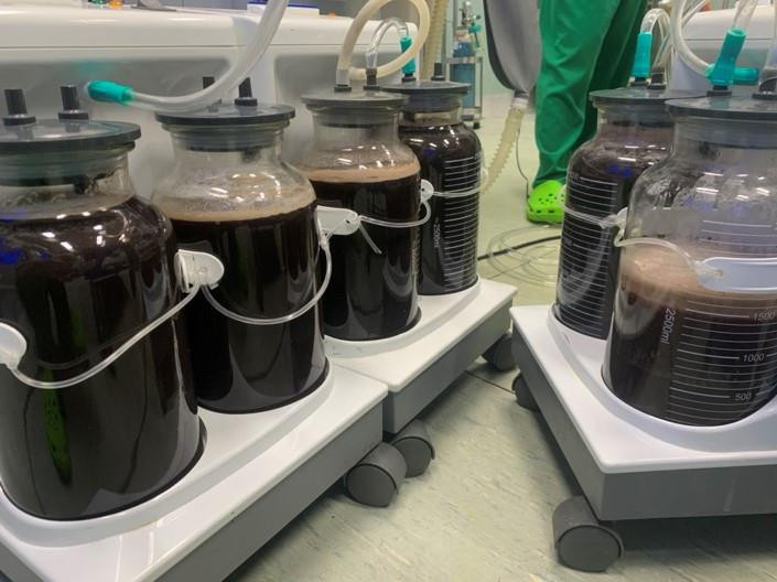 Mang khối u khủng như sắp sinh con, du học sinh trở về Việt Nam cấp cứu - 2