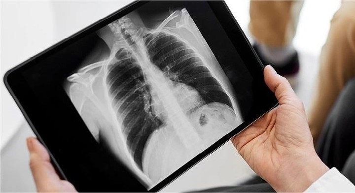 Những người thuộc nhóm nguy cơ cao mắc ung thư phổi - 1