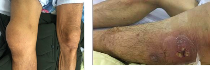 Vì sao người mắc bệnh Whitmore có nguy cơ tử vong cao? - 1