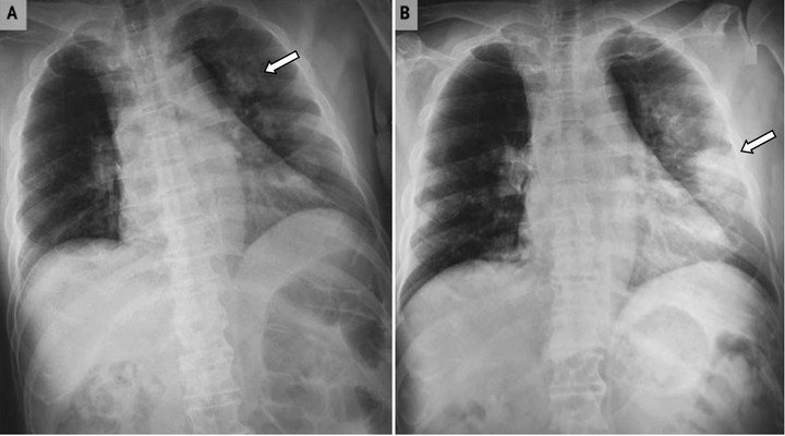 Hỗ trợ thuốc miễn phí cho bệnh nhân xơ phổi vô căn tại 9 bệnh viện - 1