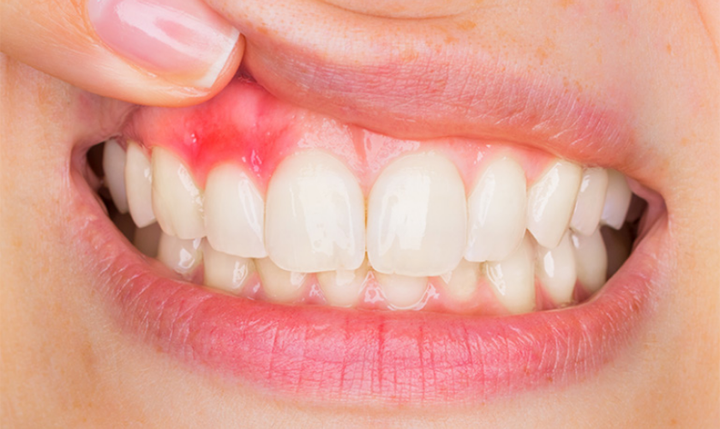 Ảnh hưởng nghiêm trọng của nhiệt miệng đối với trẻ các mẹ phải lưu ý - 2