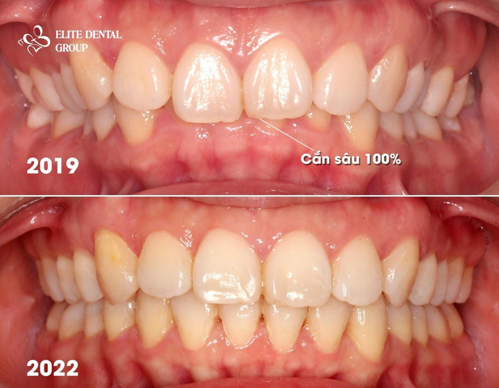 Niềng răng vô hình có hiệu quả không? - 2