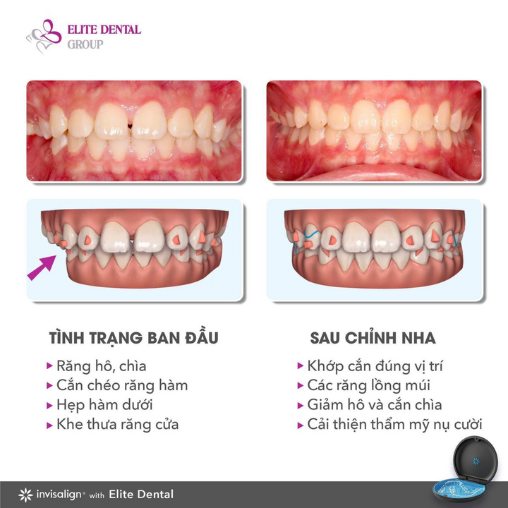 Niềng răng vô hình có hiệu quả không? - 3