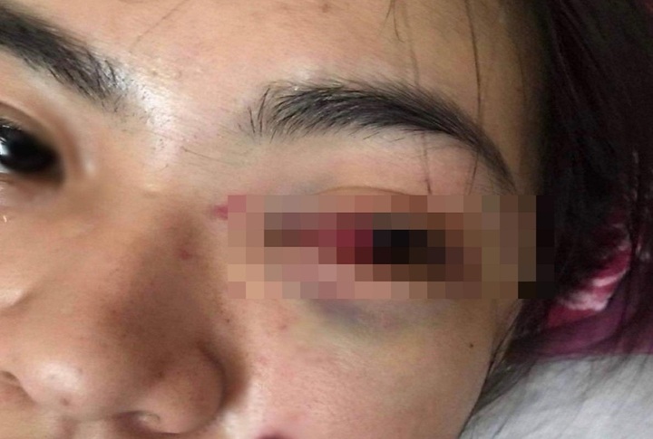 Hà Tĩnh: Nữ sinh lớp 11 bị nhóm bạn đánh tụ máu mắt - 1