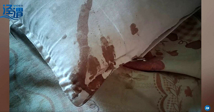 Thức giấc vì đau, người đàn ông sợ hãi thấy tai mình bị chuột cắn nham nhở - 1