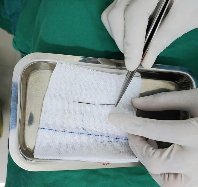 Bác sĩ kịp thời gắp kim may quần áo trong phổi bé trai 4 tuổi - 1