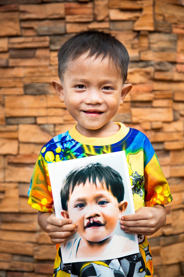 La Pomme và Tổ chức Phẫu thuật Nụ cười chung tay tạo ra nhiều nụ cười trẻ thơ - 3