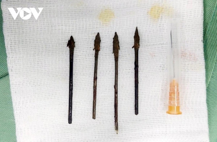 Bé trai 11 tuổi bị nhiều mũi tên sắt găm sâu vào mặt - 1