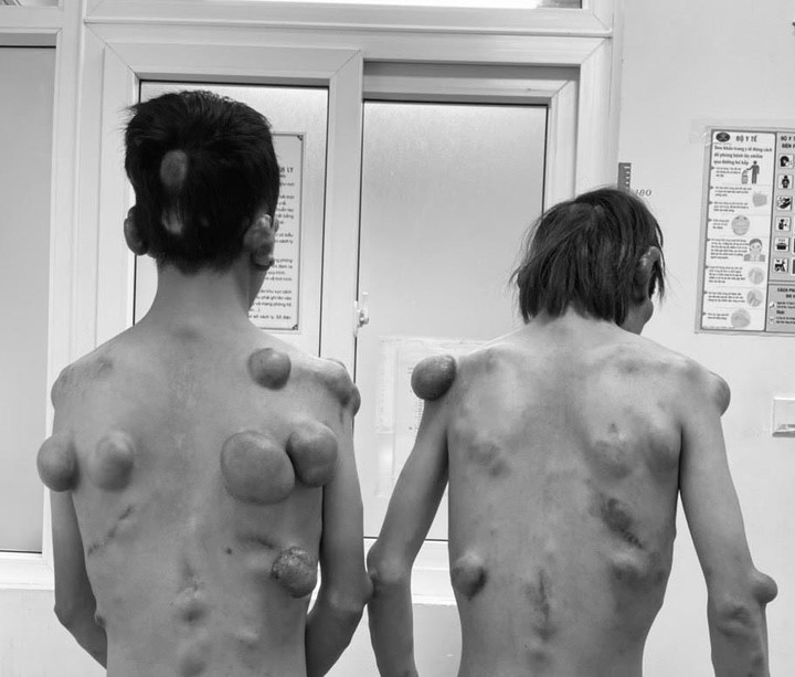 Phẫu thuật thành công cho 2 anh em sinh đôi bị mọc khối u chi chít khắp người - 1