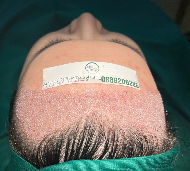 Lý do nhiều người chọn Phòng khám Black Hair để đến điều trị rụng tóc - 3