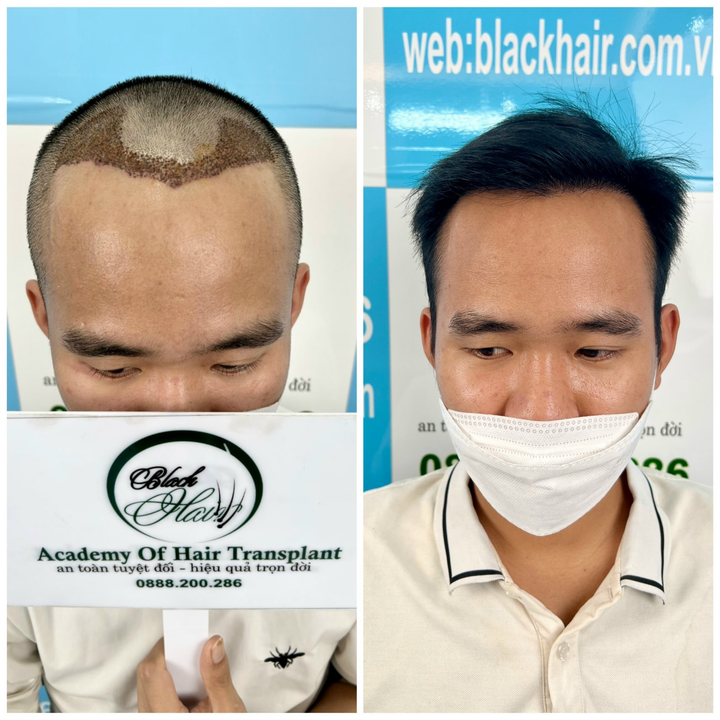 Lý do nhiều người chọn Phòng khám Black Hair để đến điều trị rụng tóc - 4