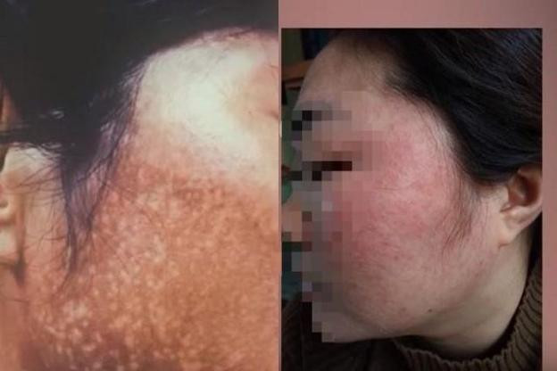 Phát hiện mẫu kem chuyên nám có hàm lượng thủy ngân vượt mức - 1