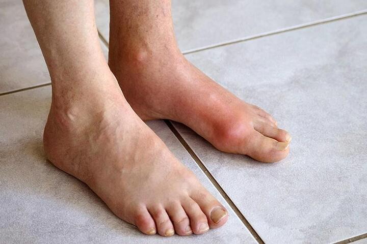 Chế độ dinh dưỡng phù hợp cho người mắc bệnh Gout - 1