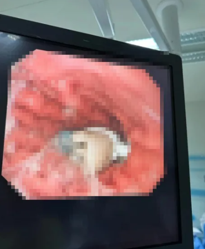 Bác sĩ sửng sốt phát hiện đầu bàn chải điện bên trong bụng cậu bé 9 tuổi - 2