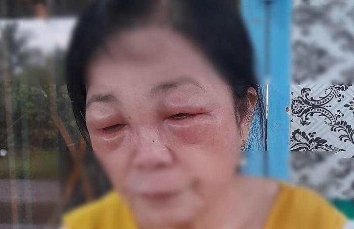 Phù mặt, tróc lở da vì nhuộm tóc đón Tết - 1