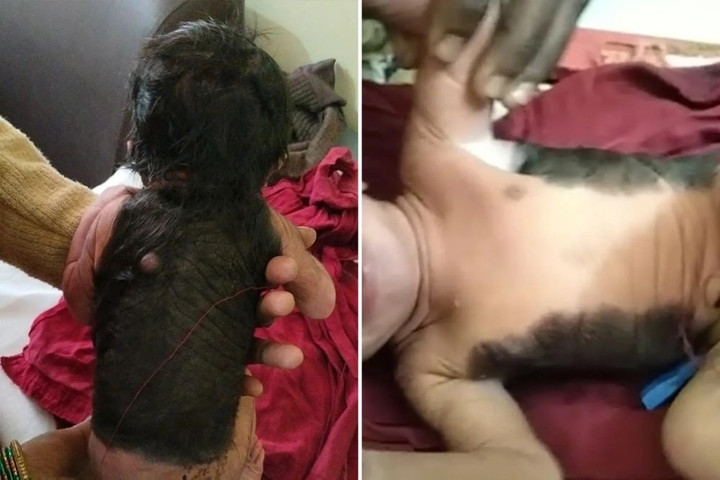 Kỳ lạ cậu bé sinh ra đã có lông, tóc khắp nửa người - 1