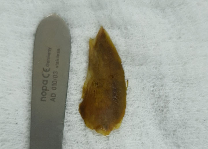 Cụ bà 89 tuổi ở Quảng Ninh bị thủng ruột non sau bữa cá rô rán - 1