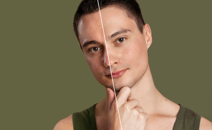 Da bị mụn mãi không khỏi, bác sỹ gợi ý cách xử trí hiệu quả để có da đẹp đón Tết - 2