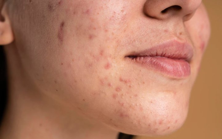 Da bị mụn mãi không khỏi, bác sỹ gợi ý cách xử trí hiệu quả để có da đẹp đón Tết - 1