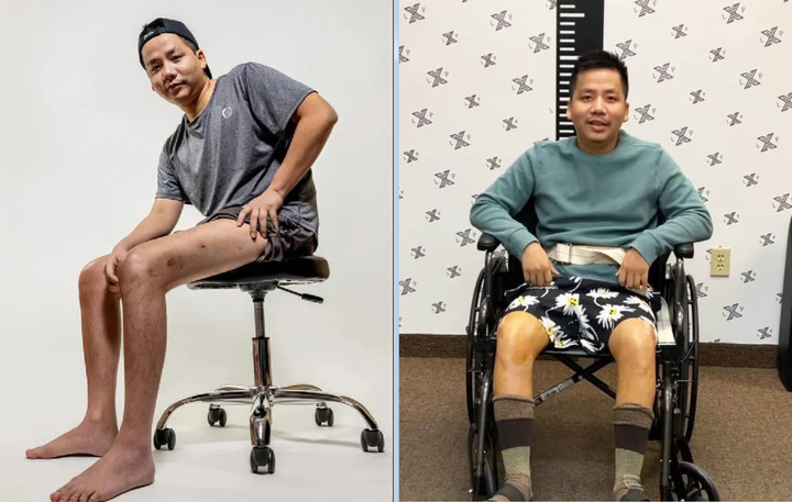 Chi tiền tỷ kéo dài chân, vẻ ngoài YouTuber Khoa Pug hiện tại thế nào? - 1