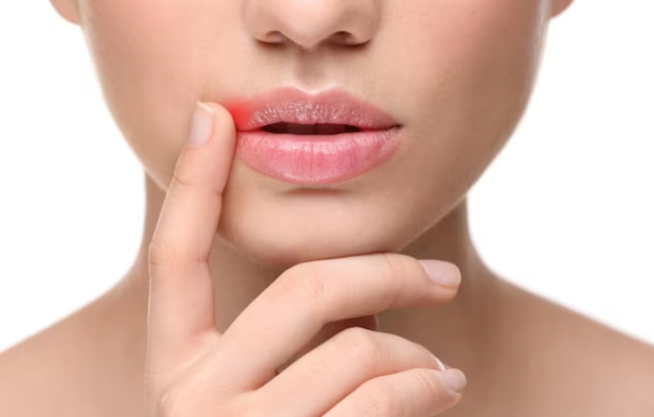 Đọc vị nguyên nhân gây nứt nẻ môi, viêm khóe miệng mãi không khỏi - 1