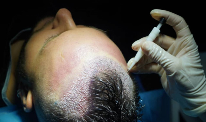 Bác sĩ da liễu Duy Thành giải đáp thắc mắc về phục hồi tóc, cấy tóc tự thân - 2