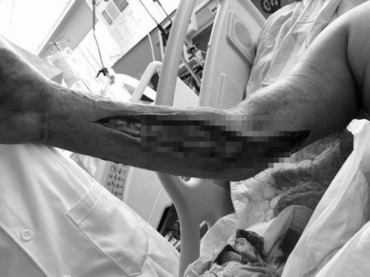 Căn bệnh khiến chàng trai 25 tuổi phải đoạn chi để giữ mạng sống - 1