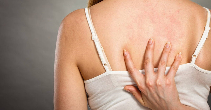 9 cách trị mụn lưng hiệu quả tại nhà, bạn nên biết - 1