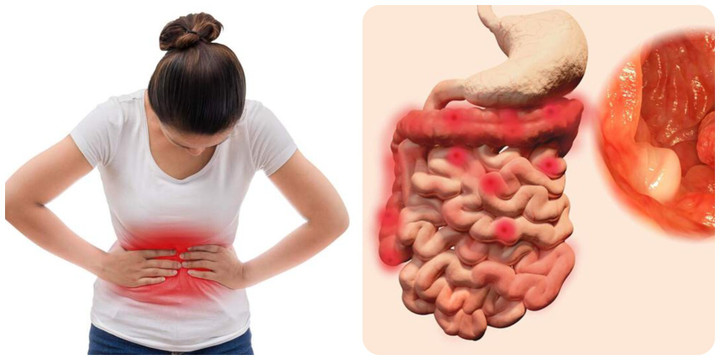 Triệu chứng ung thư đại tràng giai đoạn đầu ít người chú ý - 1