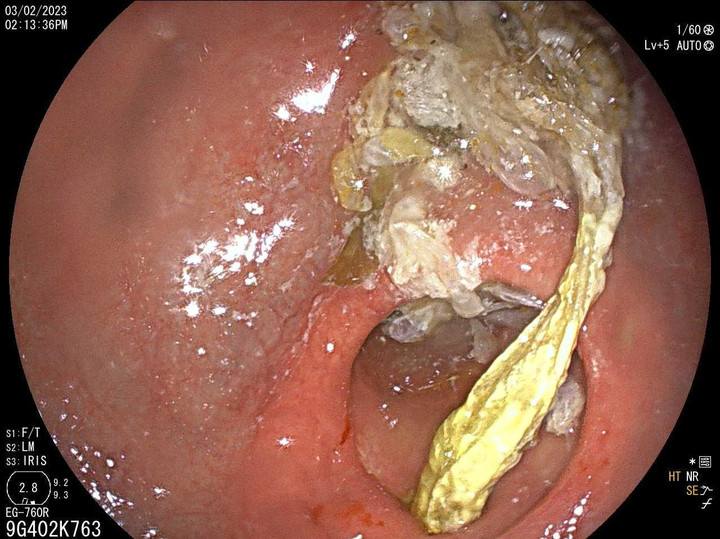 Người đàn ông suy kiệt vì bã thức ăn dài 20cm trong dạ dày - 1