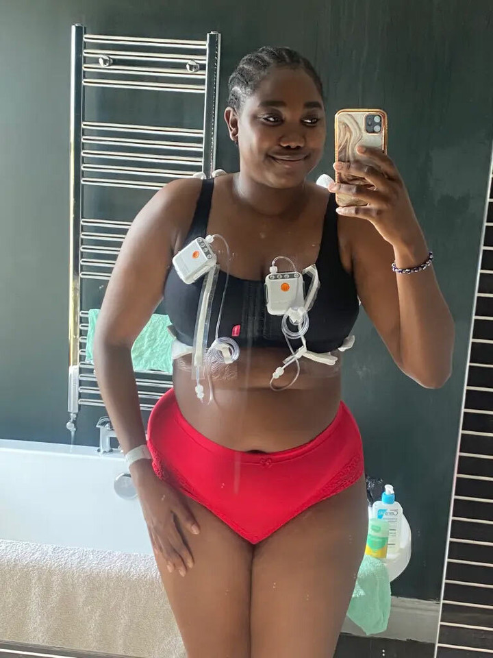 Vòng 1 lớn gây khó thở, cô gái chi 200 triệu đồng phẫu thuật thu nhỏ - 2