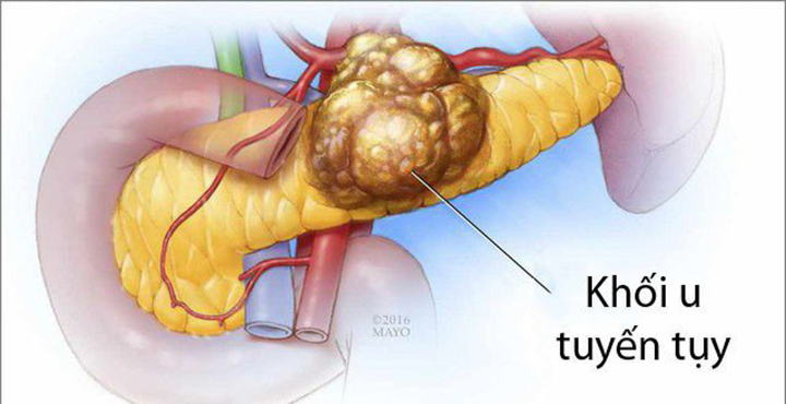 Triệu chứng ung thư tuyến tụy giai đoạn đầu - 3
