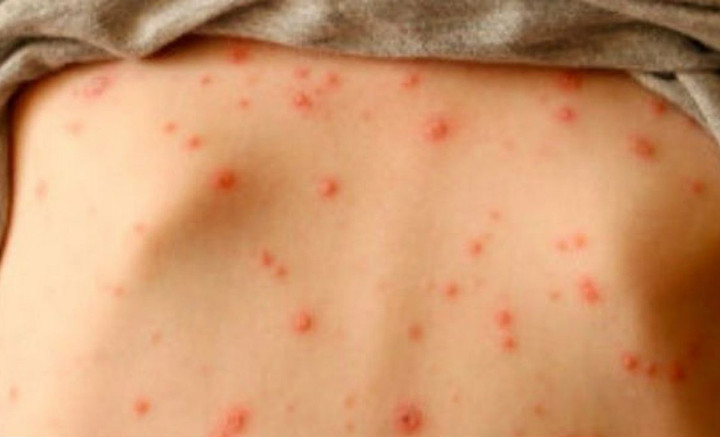 Bệnh thuỷ đậu ở người lớn: Bác sĩ lưu ý những biến chứng viêm phổi, viêm não - 1