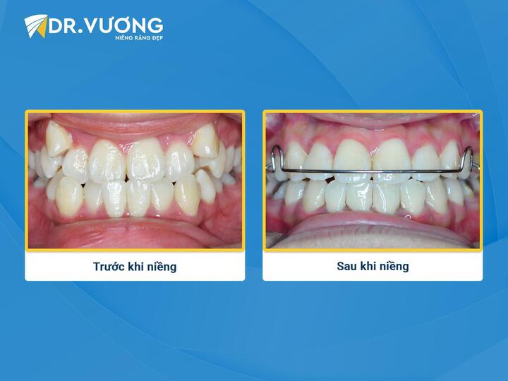 Tại sao phải tái khám sau niềng răng ít nhất một năm? - 2
