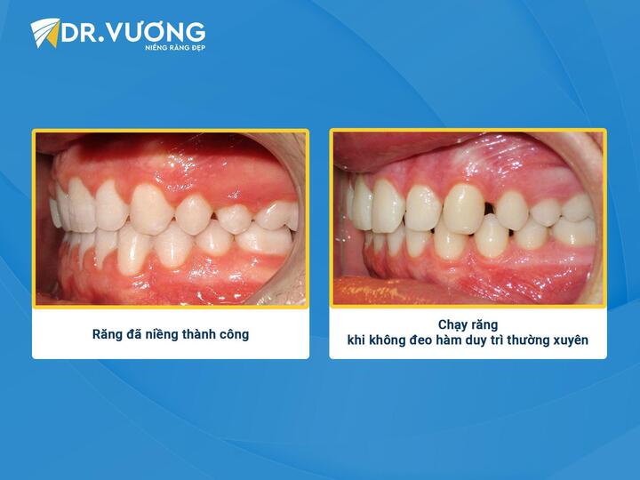 Tại sao phải tái khám sau niềng răng ít nhất một năm? - 4