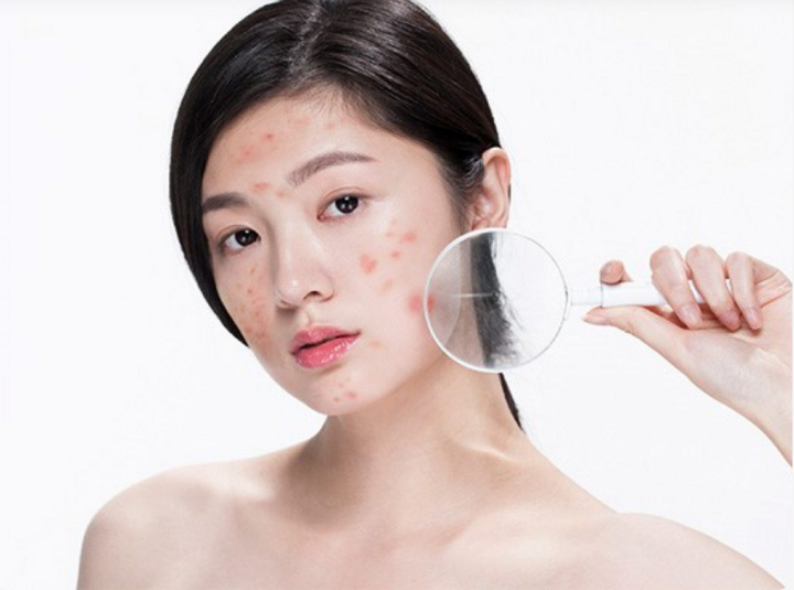 Mụn trứng cá gây thâm rỗ mặt: Bác sĩ da liễu mách cách chăm sóc da tốt nhất - 2
