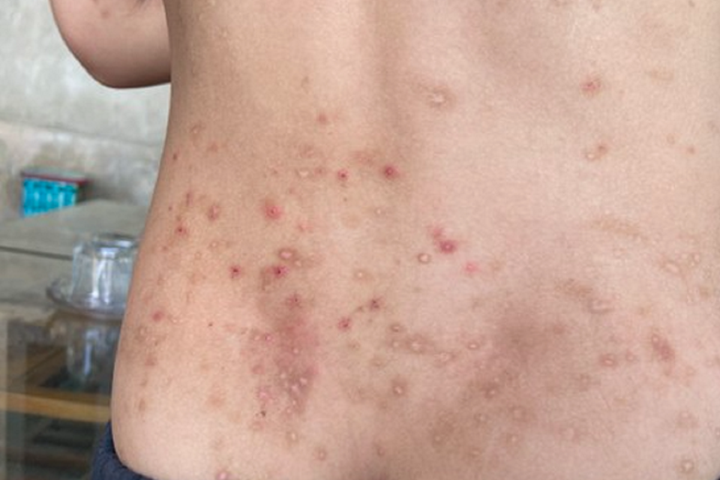 Hàng trăm người ở Hà Tĩnh bị bọ chét đốt gây sẩn ngứa khắp người - 1