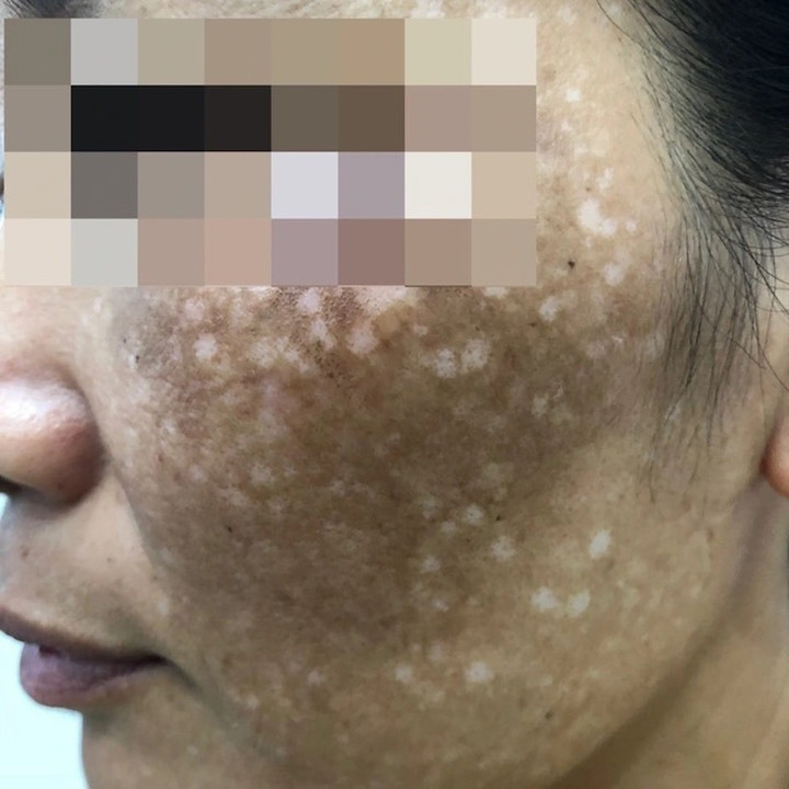 Học Tiktok đun nước lá trị nám, 4 phụ nữ mặt loang lổ sau một đêm - 1