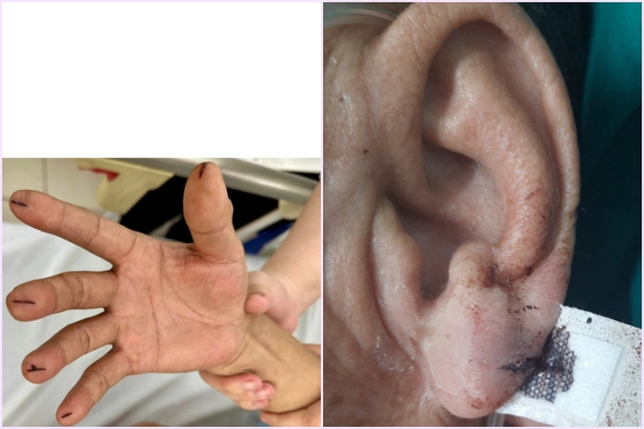 7 việc cần làm khi sơ cứu người bị đột quỵ não - 1