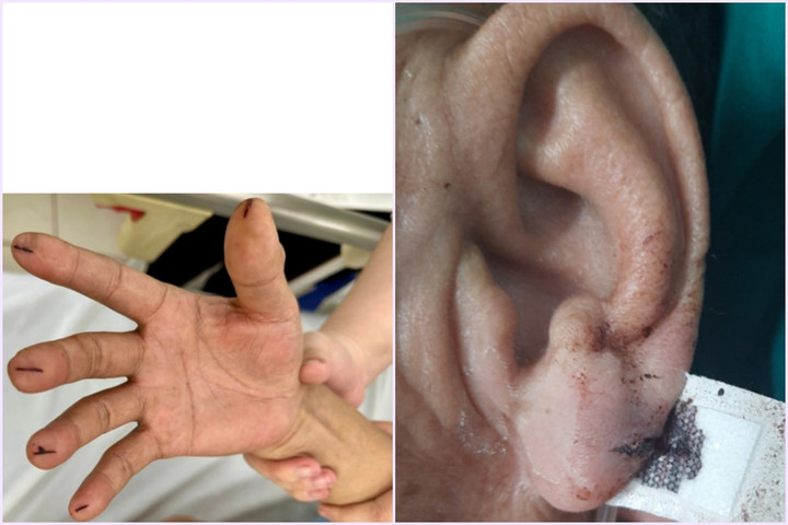 Rước họa vì nghe theo 'bác sĩ TikTok' chích máu đầu ngón tay chữa đột quỵ - 1