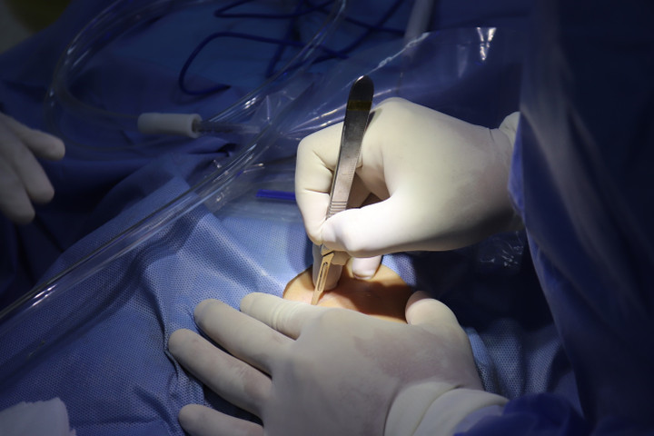 Biến chứng cần biết khi phẫu thuật nâng mũi cấu trúc bằng sụn sườn và sụn tai - 1