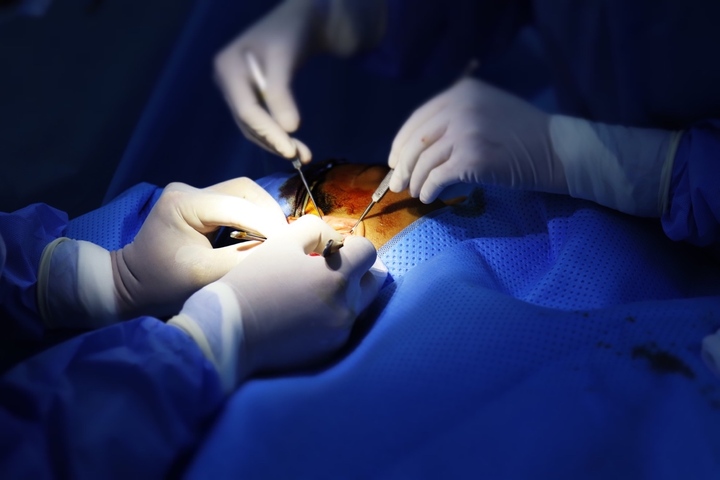 Biến chứng cần biết khi phẫu thuật nâng mũi cấu trúc bằng sụn sườn và sụn tai - 2