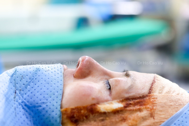 Biến chứng cần biết khi phẫu thuật nâng mũi cấu trúc bằng sụn sườn và sụn tai - 4