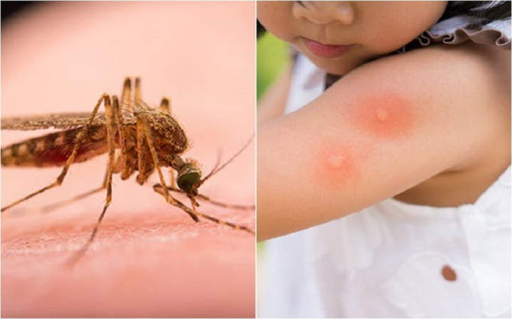 Mẹo hay giúp giảm ngứa khi bị muỗi đốt - 1