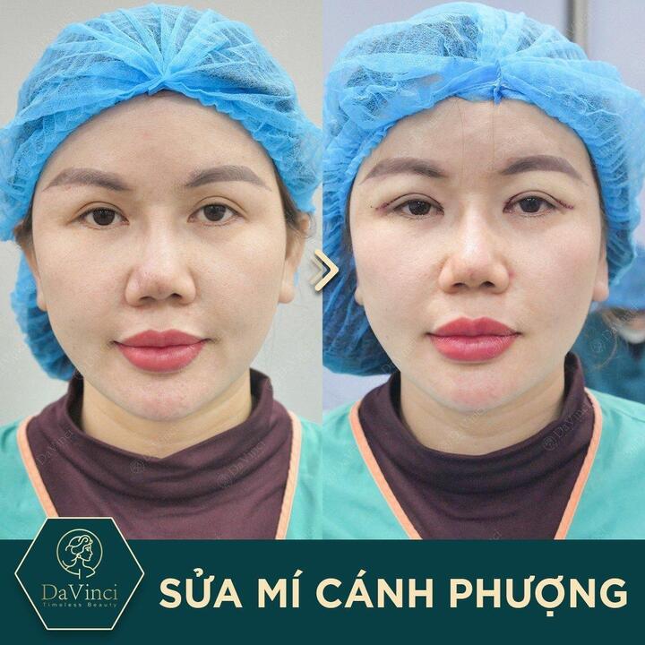Chuyên gia Viện thẩm mỹ DaVinci chia sẻ bí quyết sở hữu mắt 2 mí đẹp tự nhiên - 1