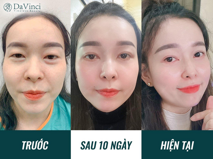 Chuyên gia Viện thẩm mỹ DaVinci chia sẻ bí quyết sở hữu mắt 2 mí đẹp tự nhiên - 4