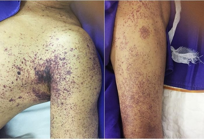 Người đàn ông ở Hà Nội tử vong sau vài ngày giết mổ lợn - 1